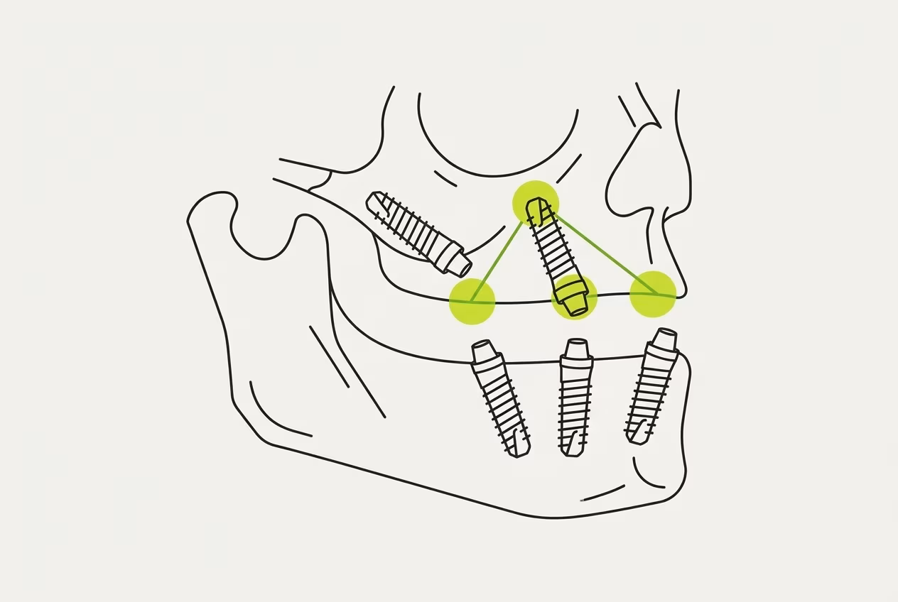 Схема 3D-планирования имплантации зубов в современной клинике Москвы